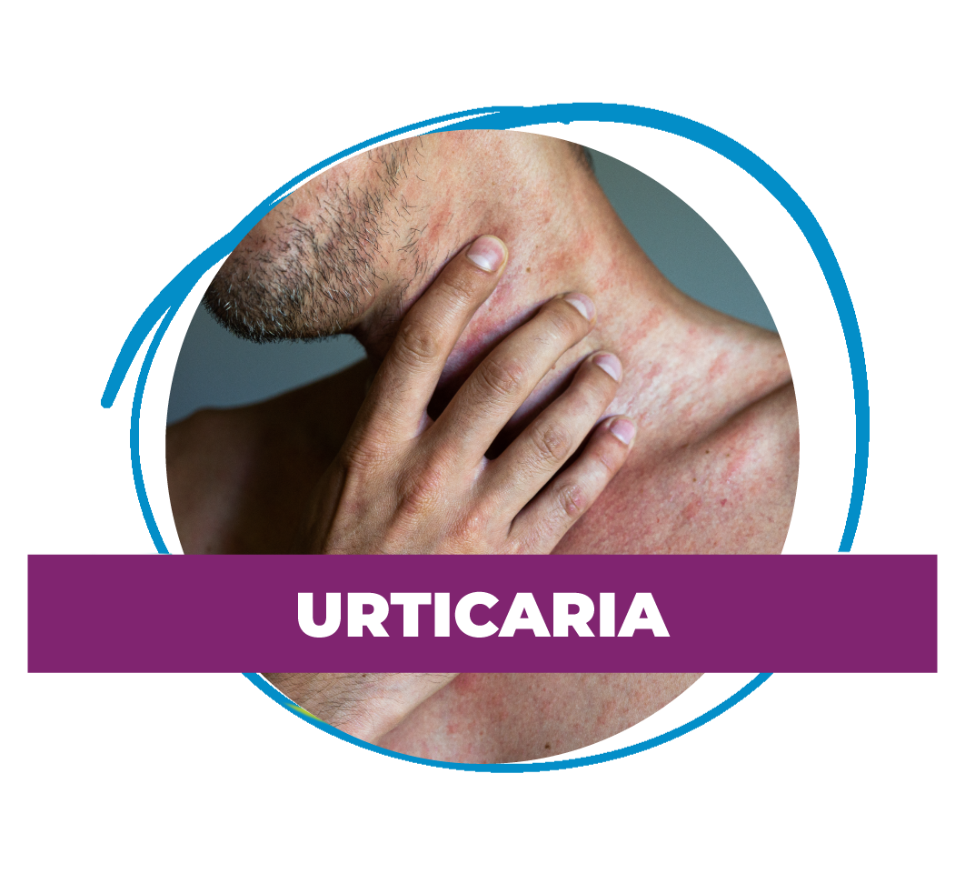 Urticaria
