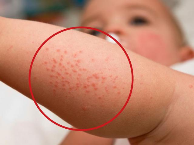Dermatitis atÃ³pica, una afecciÃ³n de la piel que comienza en la niÃ±ez y causa molestias durante toda la vida